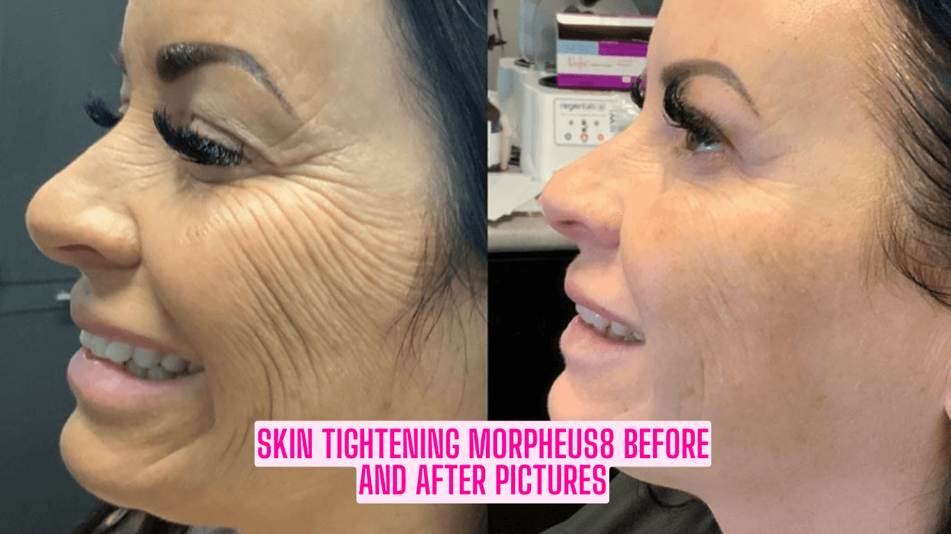 Skin Tightening Morpheus8 Before and After Pictures