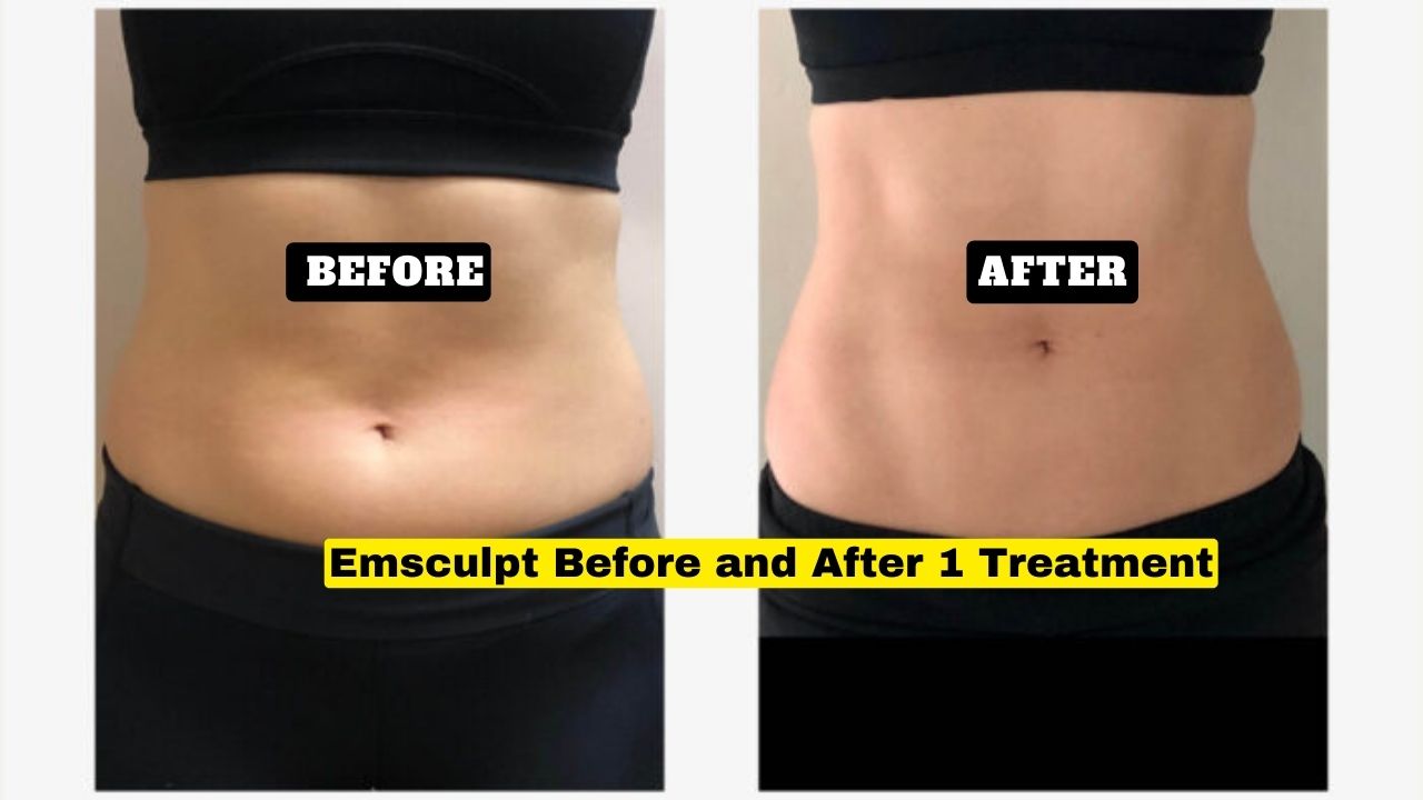 Emsculpt Before and After 1 Treatment